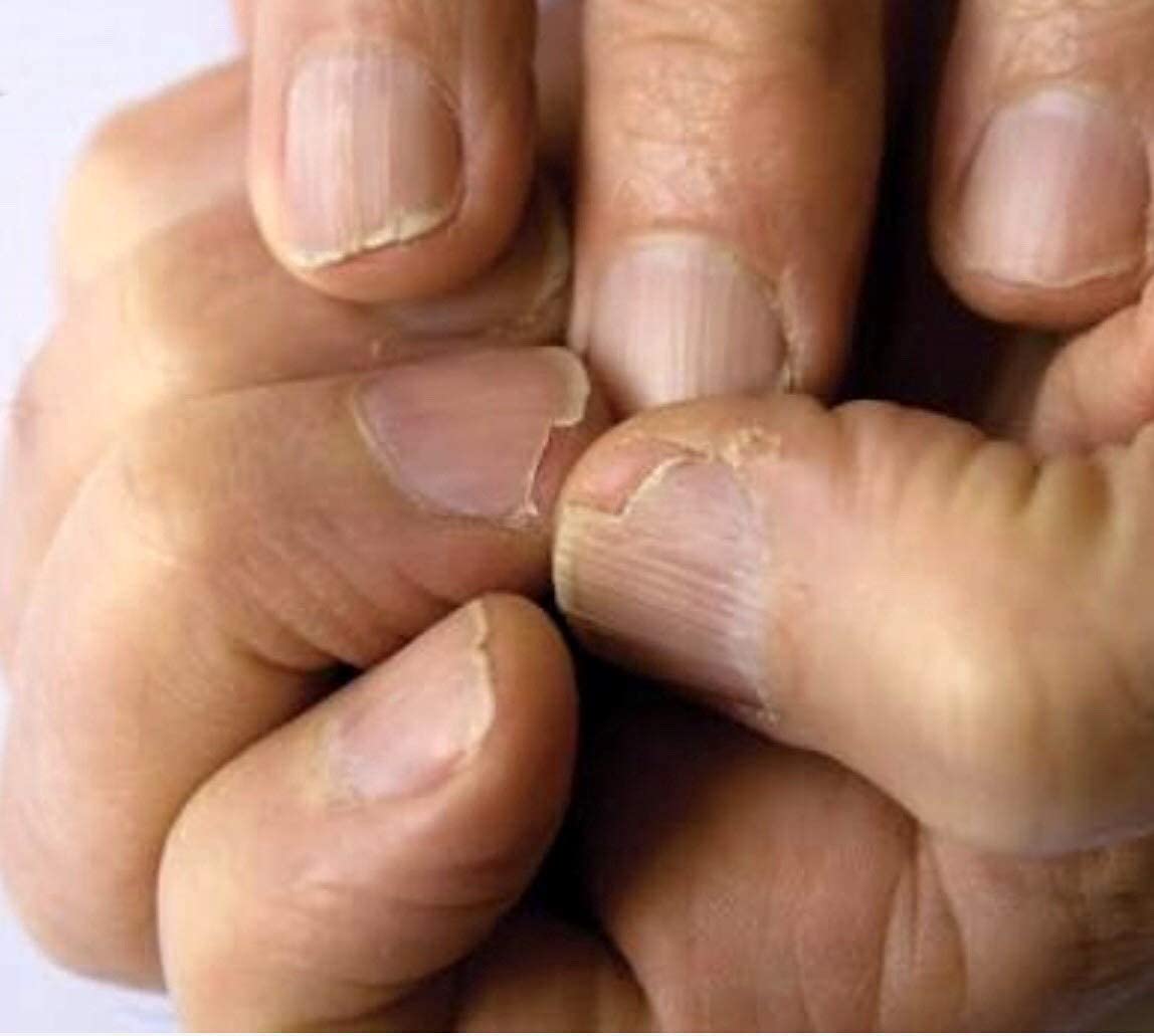 NAILVIVE Nail Serum Powerful Natural Keratin Nail Treatment Silk Proteins Proven Natural Formula Strengthening Hardening nails Instantly Prevents Splits Chips Peels Cracks on Your Nails (Bonus Pack!)