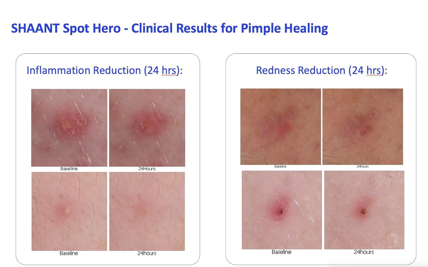 Codex Labs Shaant Spot Hero – Sulfur & Green Tea Gel for Blemish-Prone Skin | Fast-Drying Formula for Clear-Looking Skin | 0.5oz