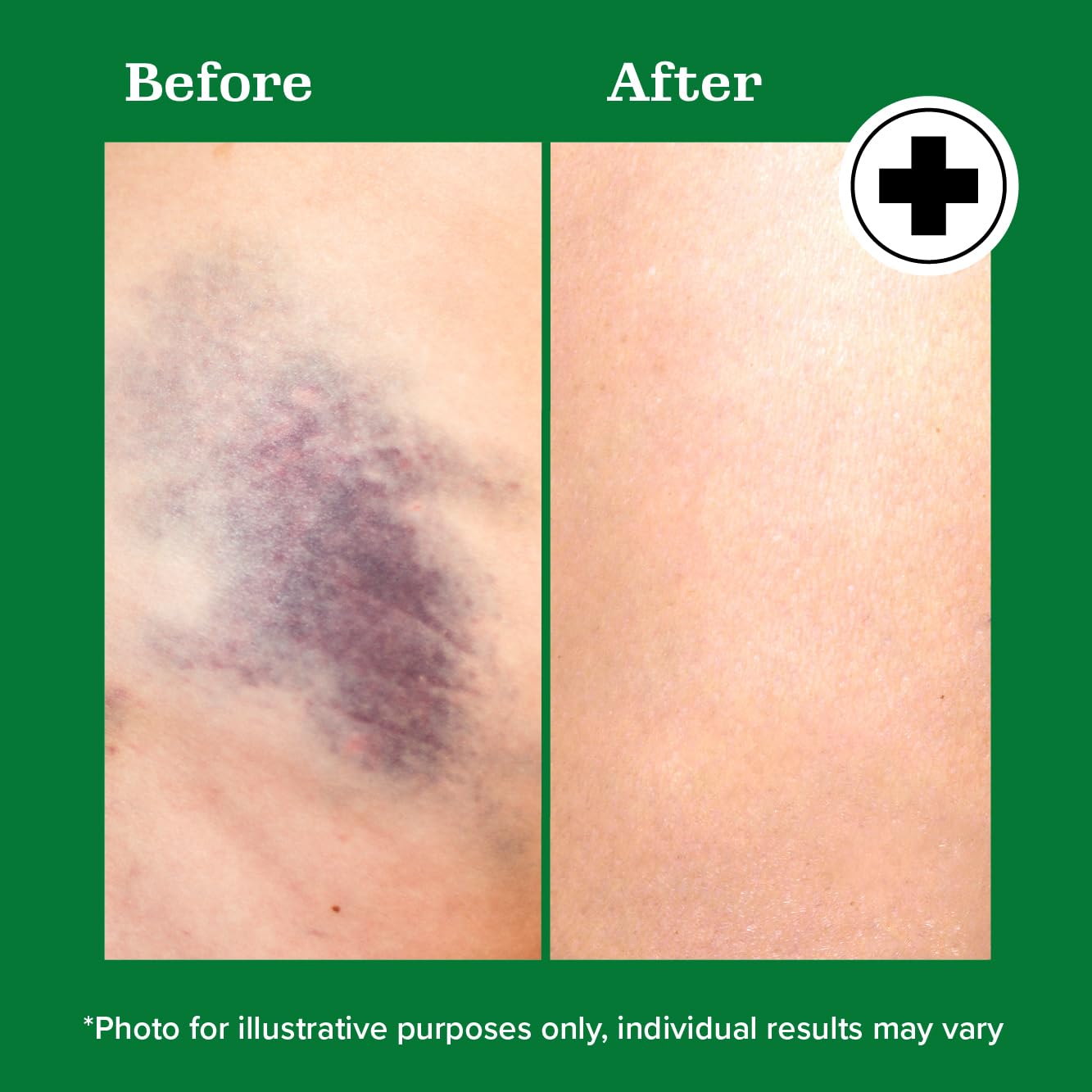 Miracle Plus Natural Arnica Bruise Body Gel | Arnica Montana Lotion For Thin Skin Bruising And Swelling After Surgery | Extra Strength Vitamin K Cream | Skin Care Ointment For Bruises, 2-Pack