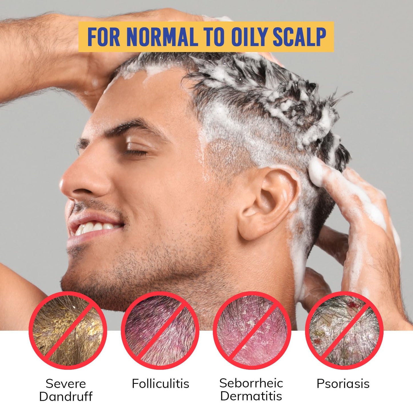 Seborrheic Dermatitis & Folliculitis Dandruff Shampoo: Anti Fungal Medicated Shampoo for Healthy Scalp with Selenium Sulfide & Botanical Extracts - Flakes Itchy and Oily Scalp Relief Stop Hair Loss