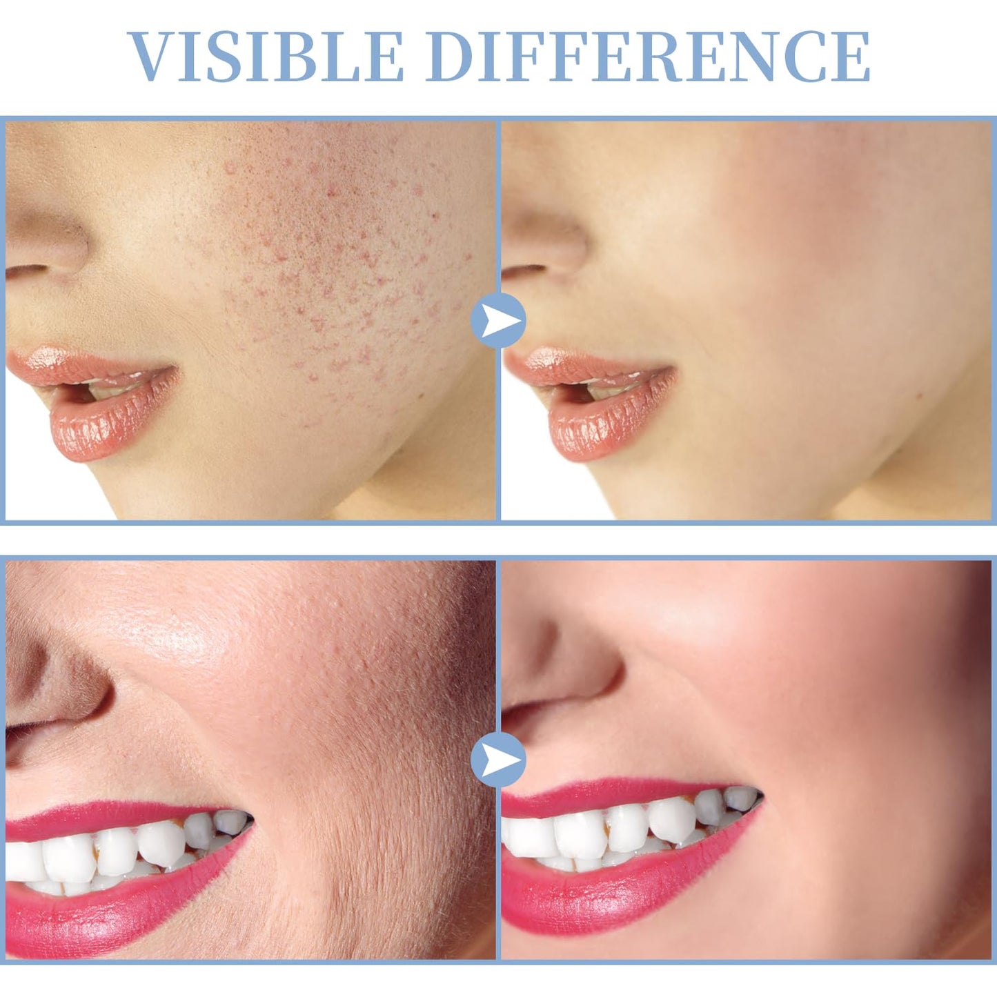 High Frequency Facial Machine - TUMAKOU Portable Handheld High Frequency Facial Skin Wand Machine with 4 Different Tubes