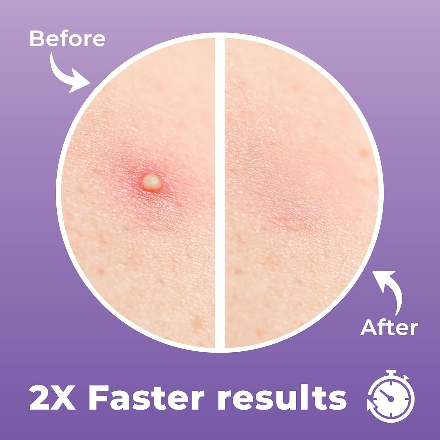 Large Pimple Patches for Face (20 Pack), Treat Blemishes Overnight, Hydrocolloid Acne Patch, Hydrocolloid Bandages, Big Pimple Patches, Large Acne Patch