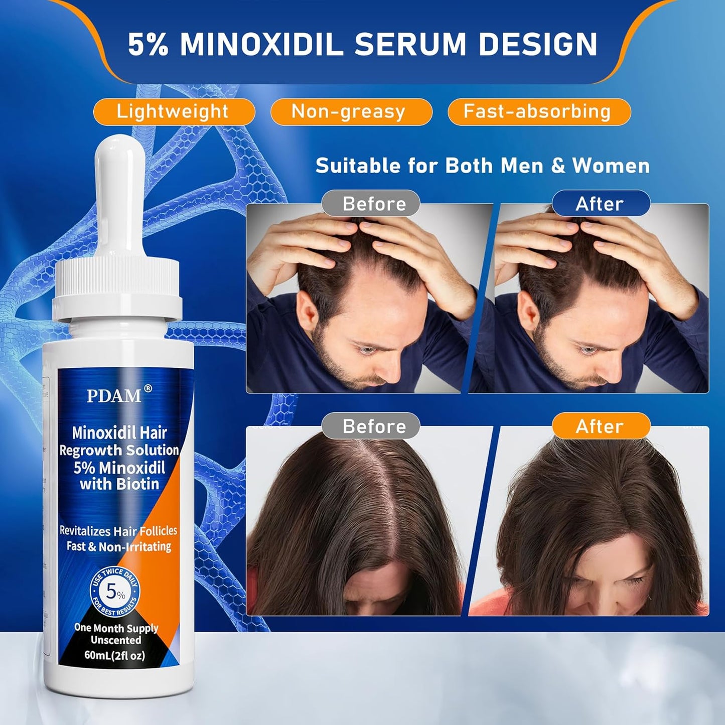 5% Minoxidil for Men Hair & Beard Growth Kit, Minoxidil for Women Hair Growth Serum, Extra Strength Hair Loss Treatment for Thinning Hair, Promotes Thicker Fuller Regrowth, Nourishes Scalp, 3 × 2oz