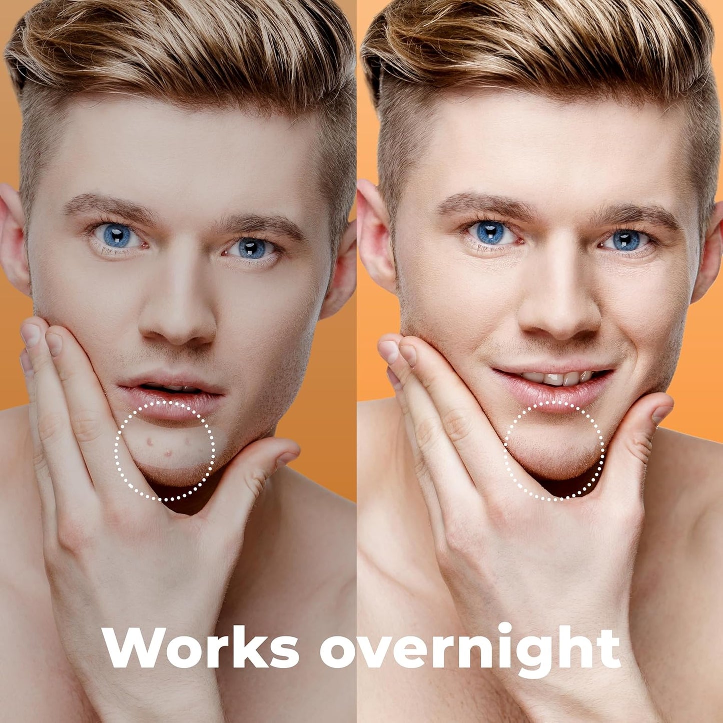 Chin Pimple Patches (12 Pack), Remove Chin Acne Overnight with Large Hydrocolloid Acne Patches For Blemishes on Chin, Cheek, Forehead